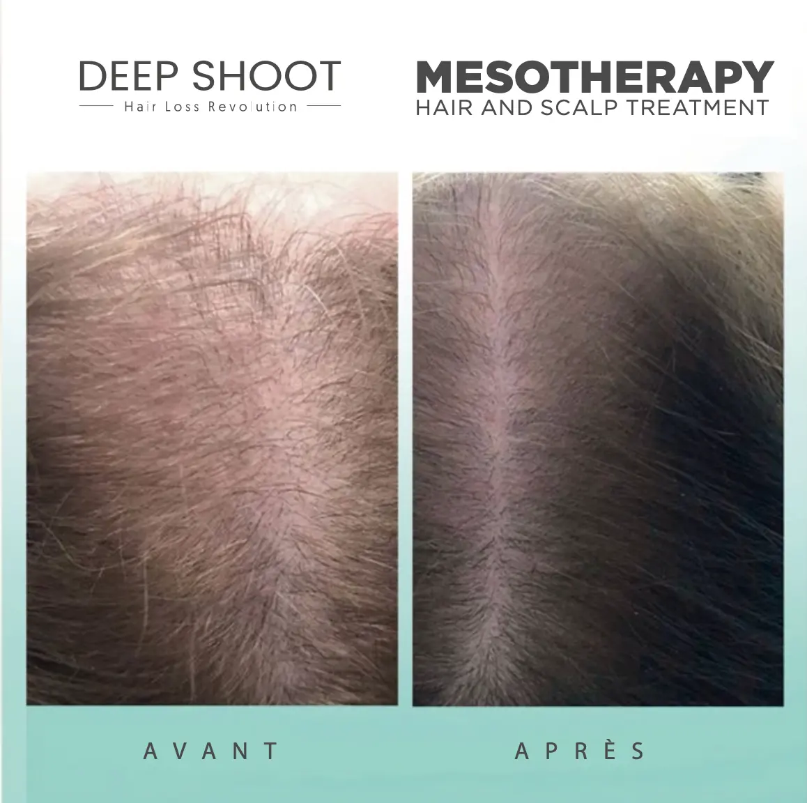 enfants-terribles-Mésothérapie-avant-après